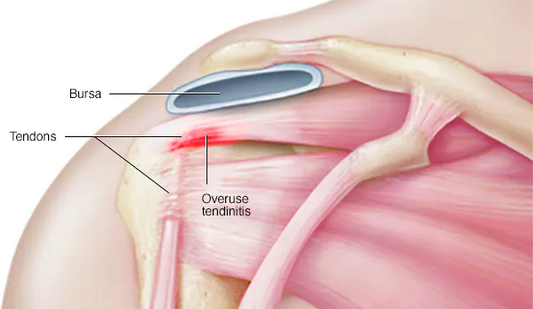 Understanding Tendonitis and How to Avoid It in Your Fitness Journey